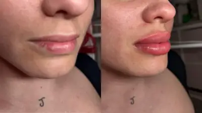 Comparativa lateral de labios antes y después de un tratamiento de micropigmentación.