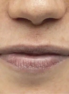 Primer plano de labios antes del tratamiento de micropigmentación.