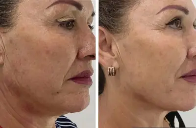 Comparativa del rostro de una mujer antes y después de un tratamiento HIFU.