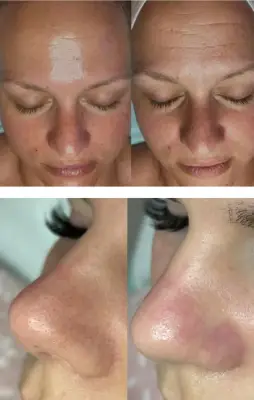 Comparativas del rostro y la nariz antes y después de un tratamiento HydraSkin.