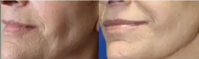 Comparativa de líneas alrededor de la boca antes y después de un tratamiento RFRAC 7.