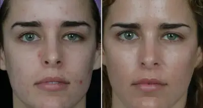 Comparativa frontal del rostro antes y después de un tratamiento facial para mejorar textura e imperfecciones.
