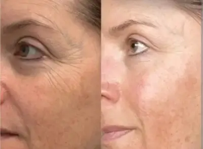 Comparativa del contorno de ojos con reducción visible de líneas de expresión.