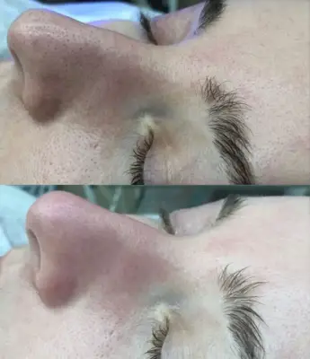 Comparativa del párpado y contorno de ojos antes y después de un tratamiento Orchidée Royale.