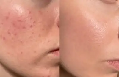 Comparativa de una mejilla con rojeces antes y piel más uniforme después del tratamiento.