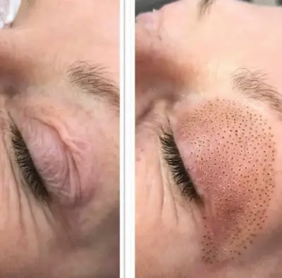 Comparativa del párpado antes y durante un tratamiento Fibroblast Plasma con puntos de aplicación.