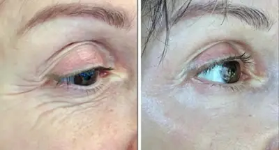 Comparativa del contorno de ojos antes y después de un tratamiento Fibroblast Plasma.