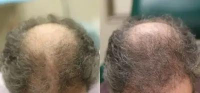 Evolución con EXO Scalp Comparativa capilar antes y después utilizada para mostrar resultados de EXO Scalp.