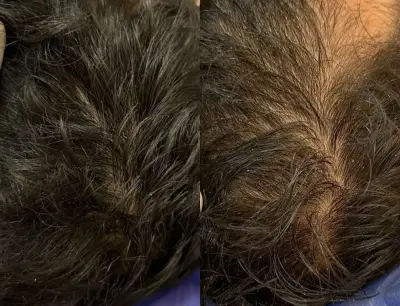 Pérdida de densidad capilar Primer plano de la coronilla con afinamiento y pérdida visible de densidad del cabello.