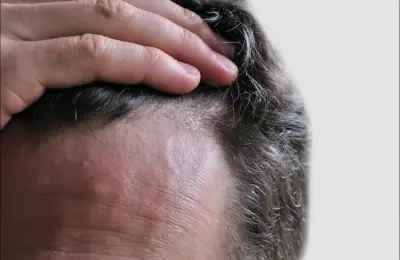 Hombre mostrando la línea frontal del cabello como referencia al tratamiento Minoxidil Regenera Plus.