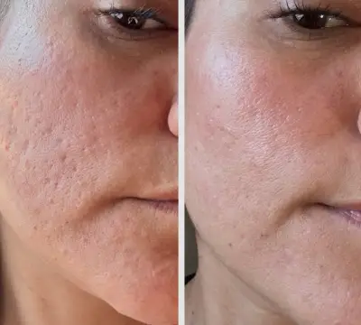 Comparativa de una mejilla antes y después con mejora de textura y poros tras microneedling Dermapen.