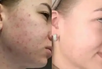 Comparativa de piel con acné antes y después con reducción visible de lesiones y rojeces.
