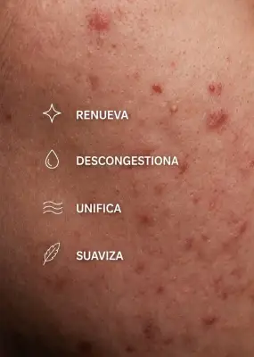 Gráfico sobre piel con acné que destaca renovación, descongestión, unificación y suavidad.